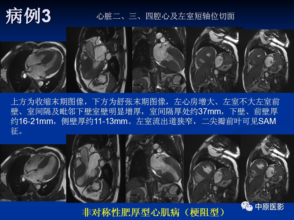 影像PPT - 【PPT】淀粉样变性心肌病的MRI表现-34