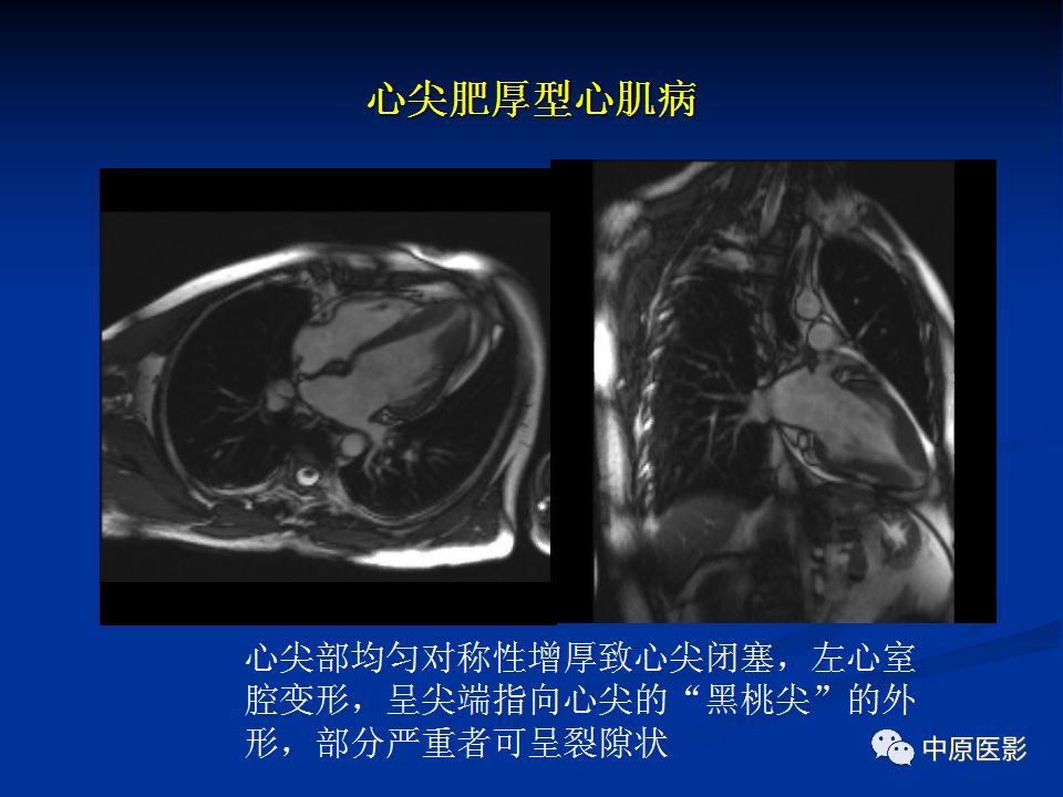 影像PPT - 【PPT】淀粉样变性心肌病的MRI表现-36