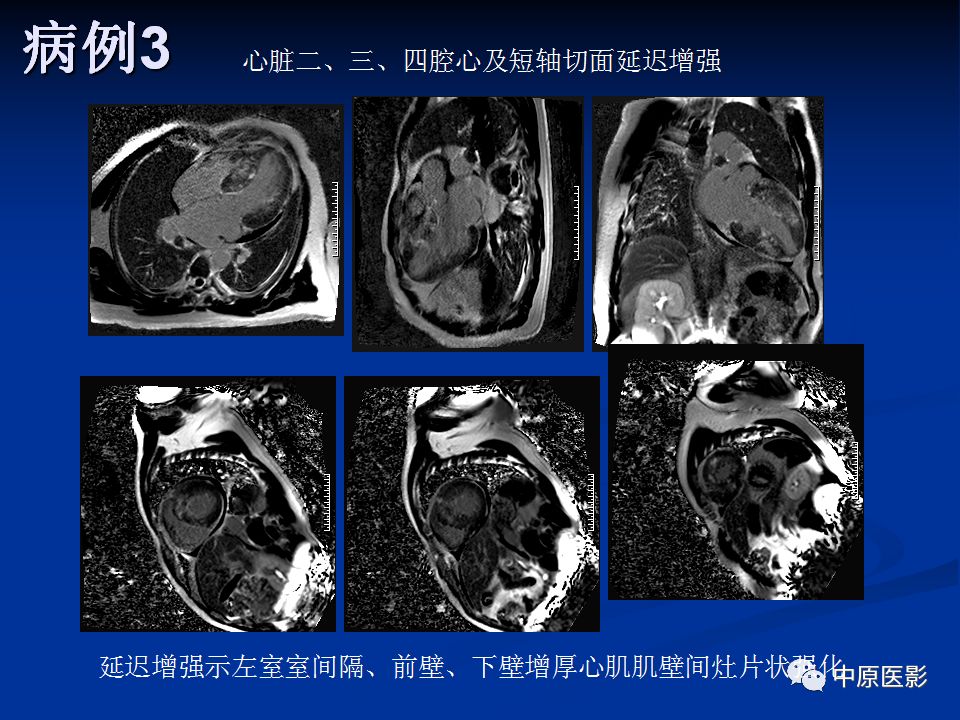 影像PPT - 【PPT】淀粉样变性心肌病的MRI表现-35