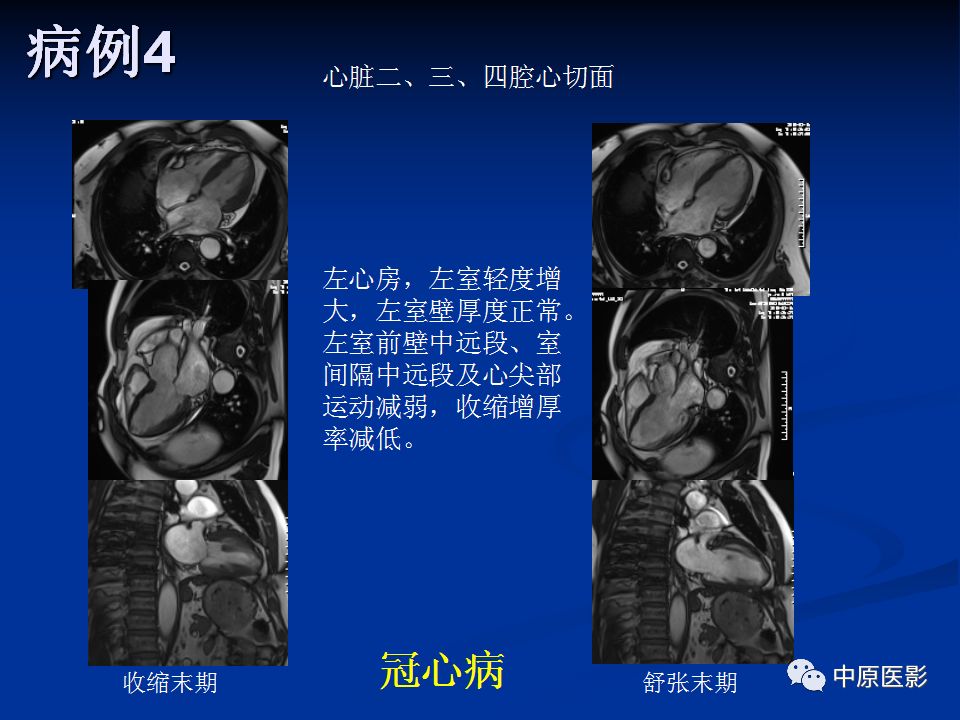 影像PPT - 【PPT】淀粉样变性心肌病的MRI表现-38