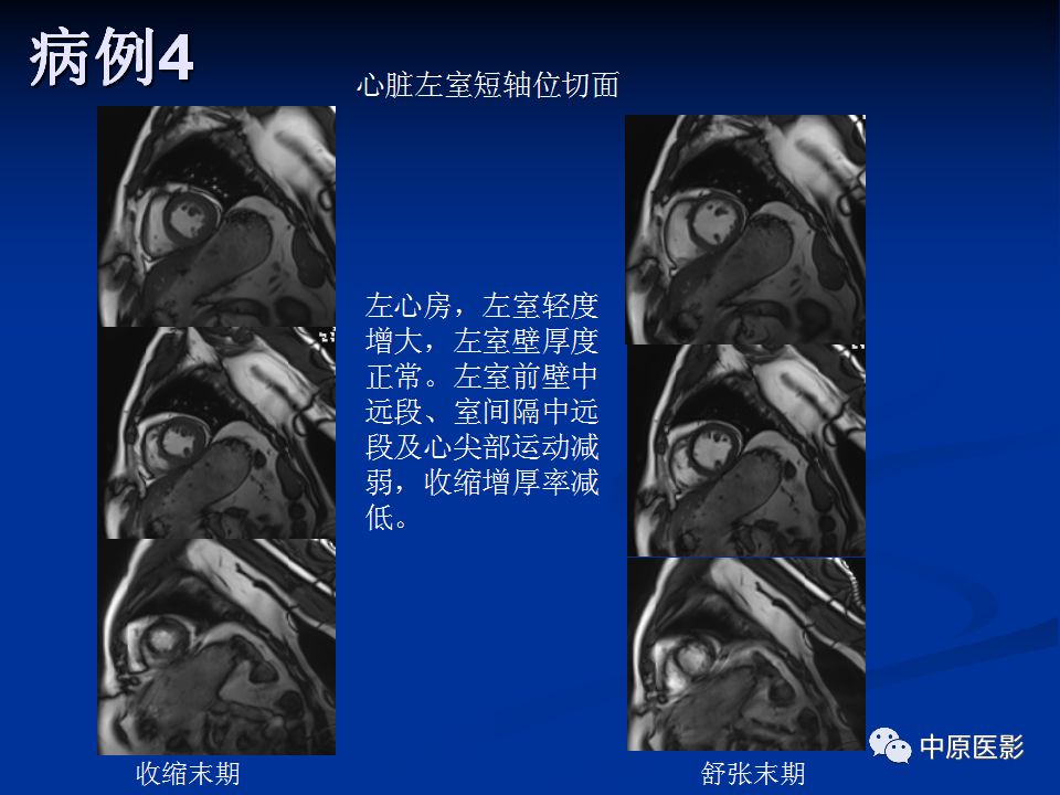 影像PPT - 【PPT】淀粉样变性心肌病的MRI表现-39