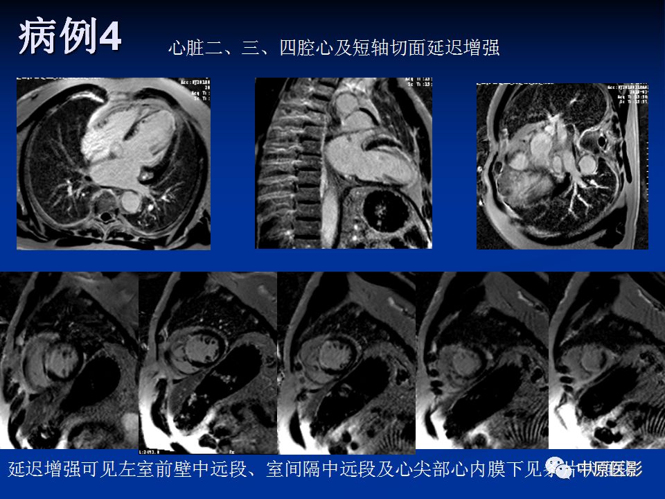 影像PPT - 【PPT】淀粉样变性心肌病的MRI表现-40