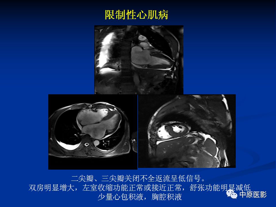 影像PPT - 【PPT】淀粉样变性心肌病的MRI表现-42