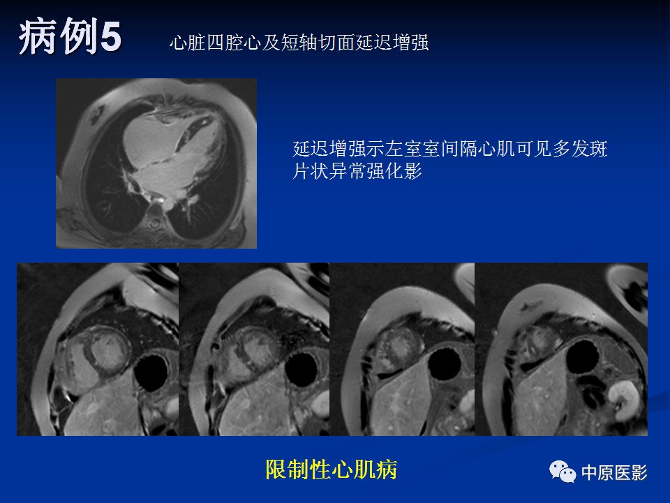 影像PPT - 【PPT】淀粉样变性心肌病的MRI表现-44