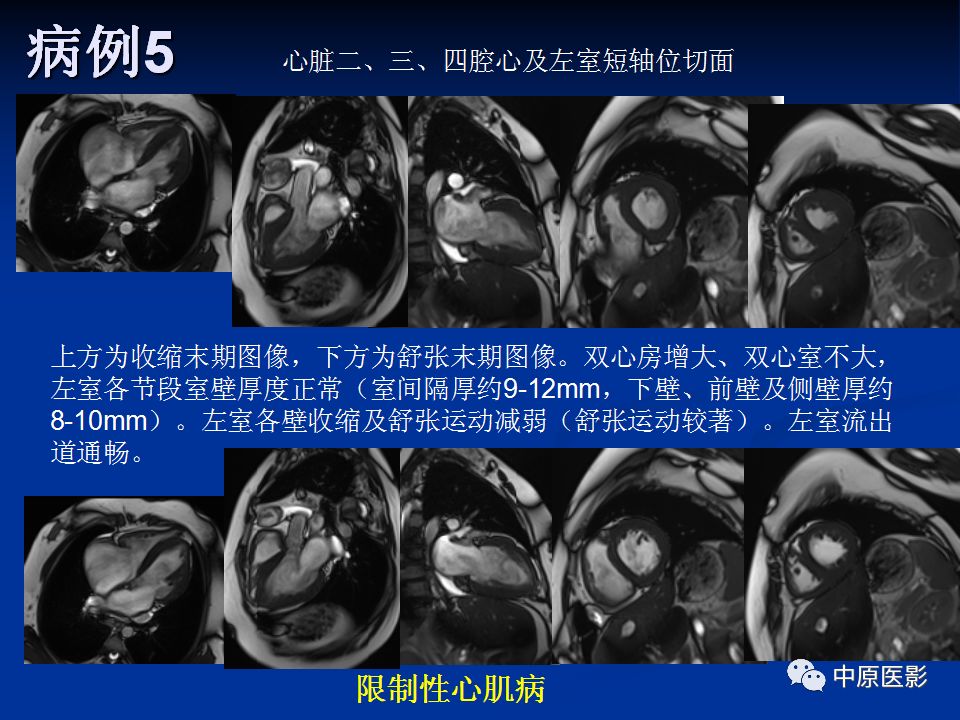 影像PPT - 【PPT】淀粉样变性心肌病的MRI表现-43