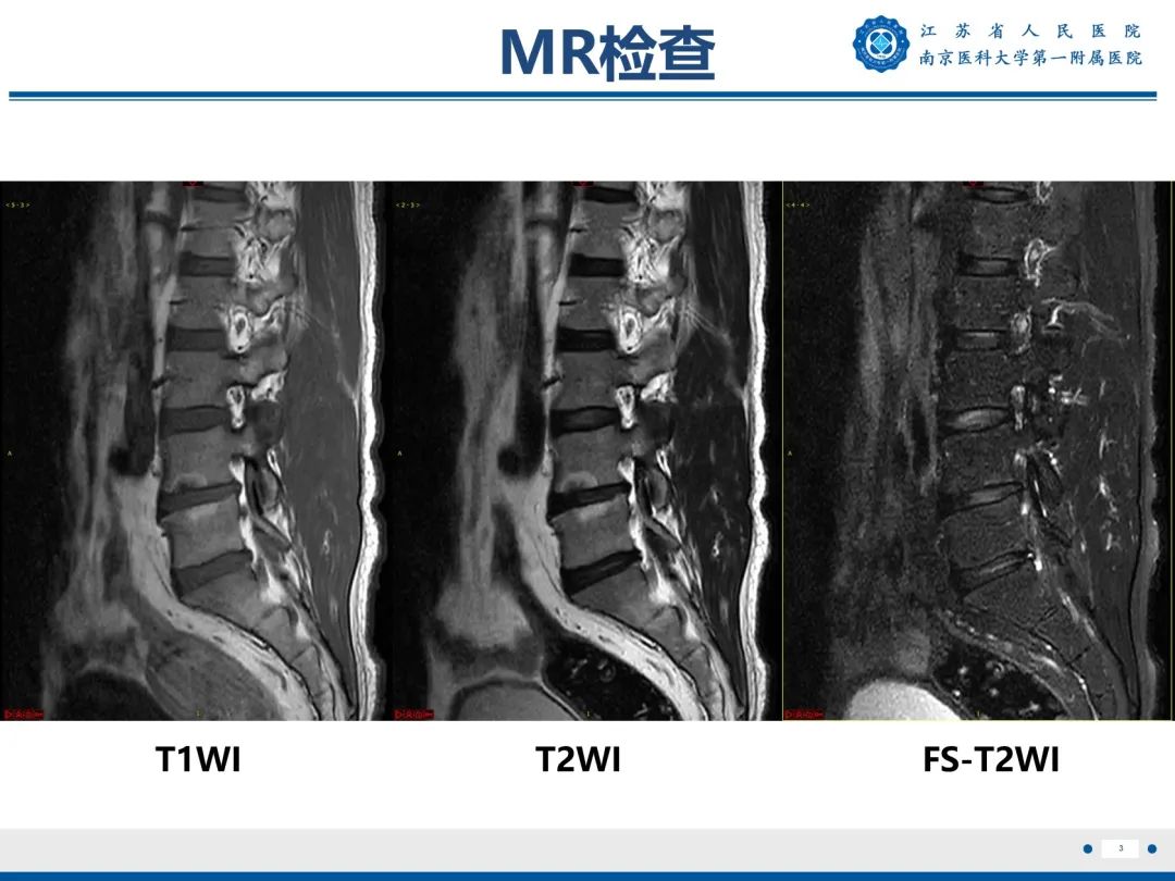 影像PPT - 【PPT】终板炎-4