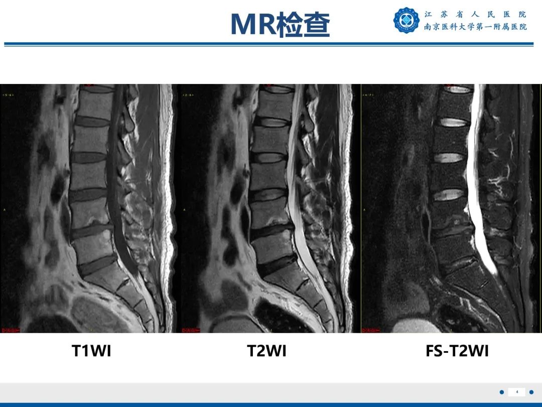 影像PPT - 【PPT】终板炎-5