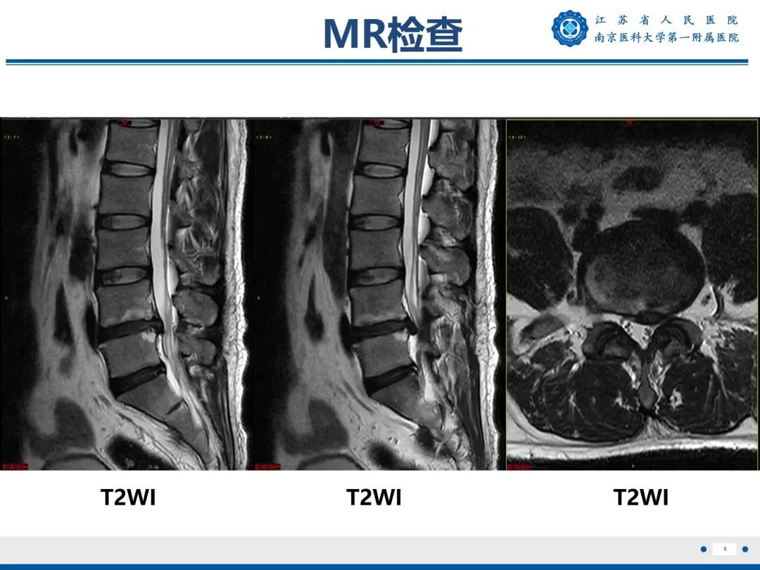 影像PPT - 【PPT】终板炎-6