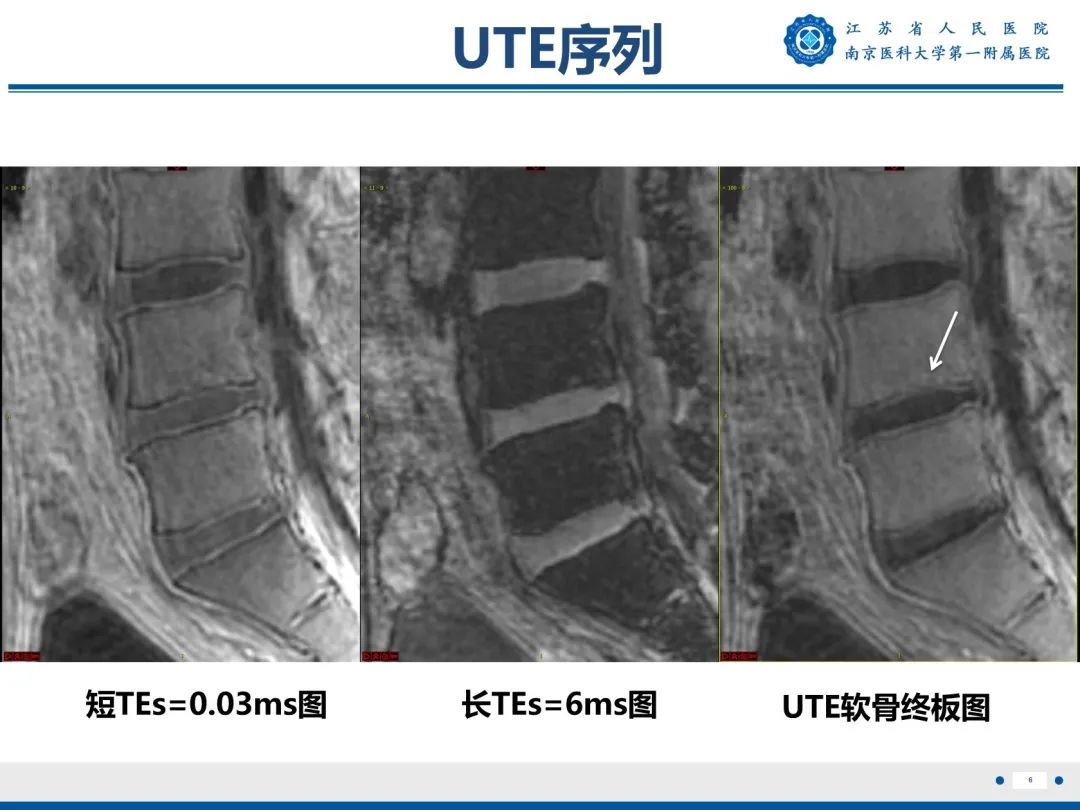 影像PPT - 【PPT】终板炎-7