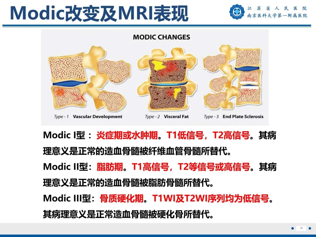 影像PPT - 【PPT】终板炎-18