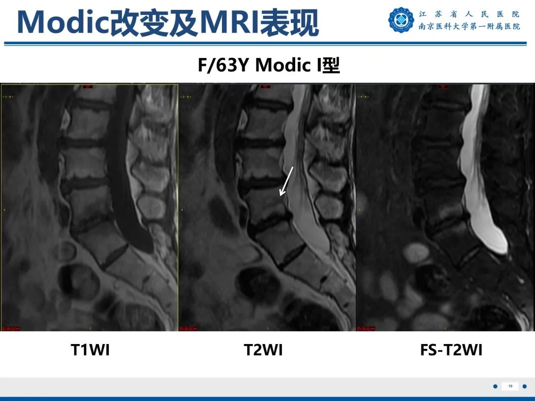 影像PPT - 【PPT】终板炎-20