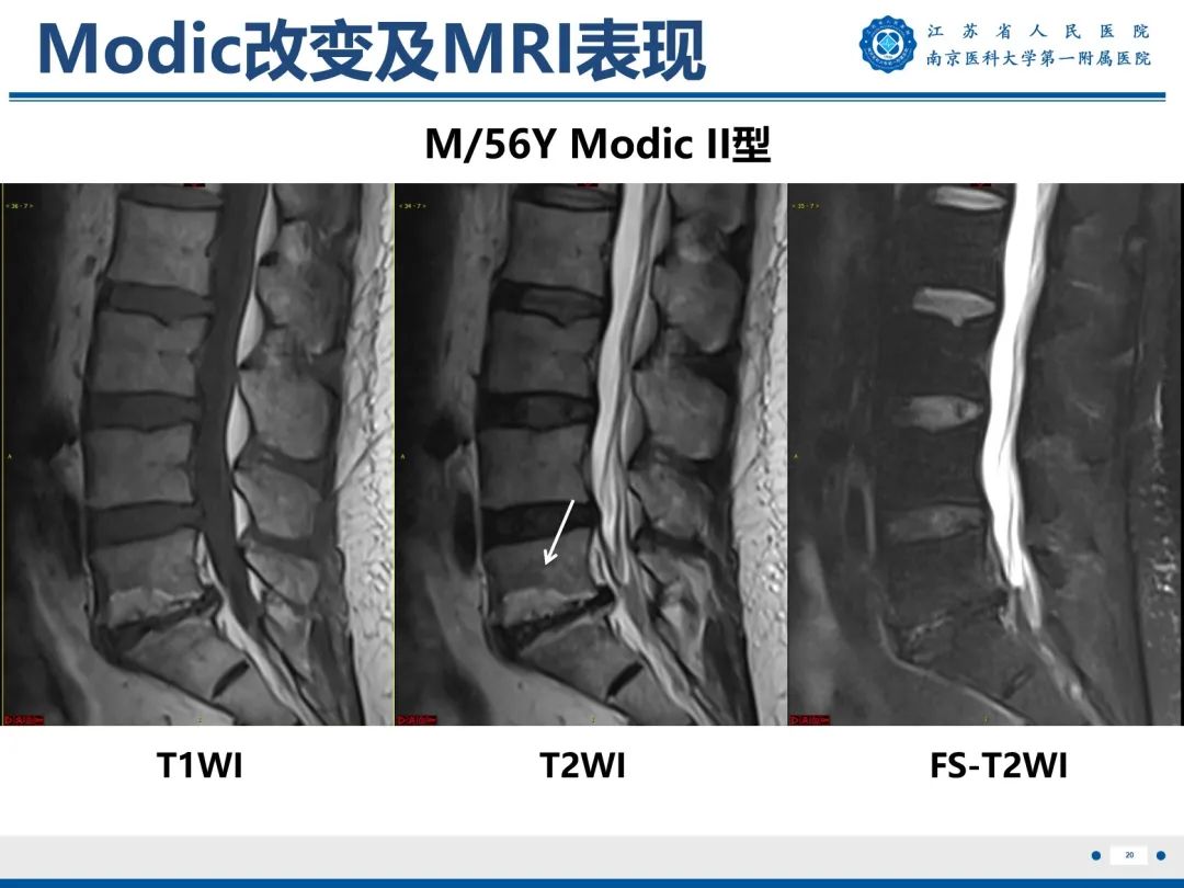 影像PPT - 【PPT】终板炎-21