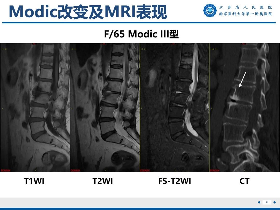影像PPT - 【PPT】终板炎-22