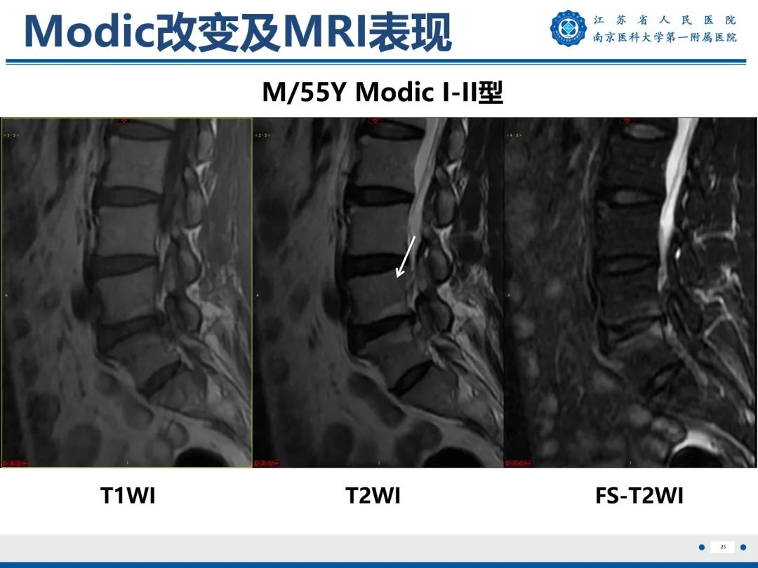 影像PPT - 【PPT】终板炎-24