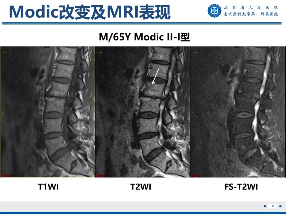 影像PPT - 【PPT】终板炎-25