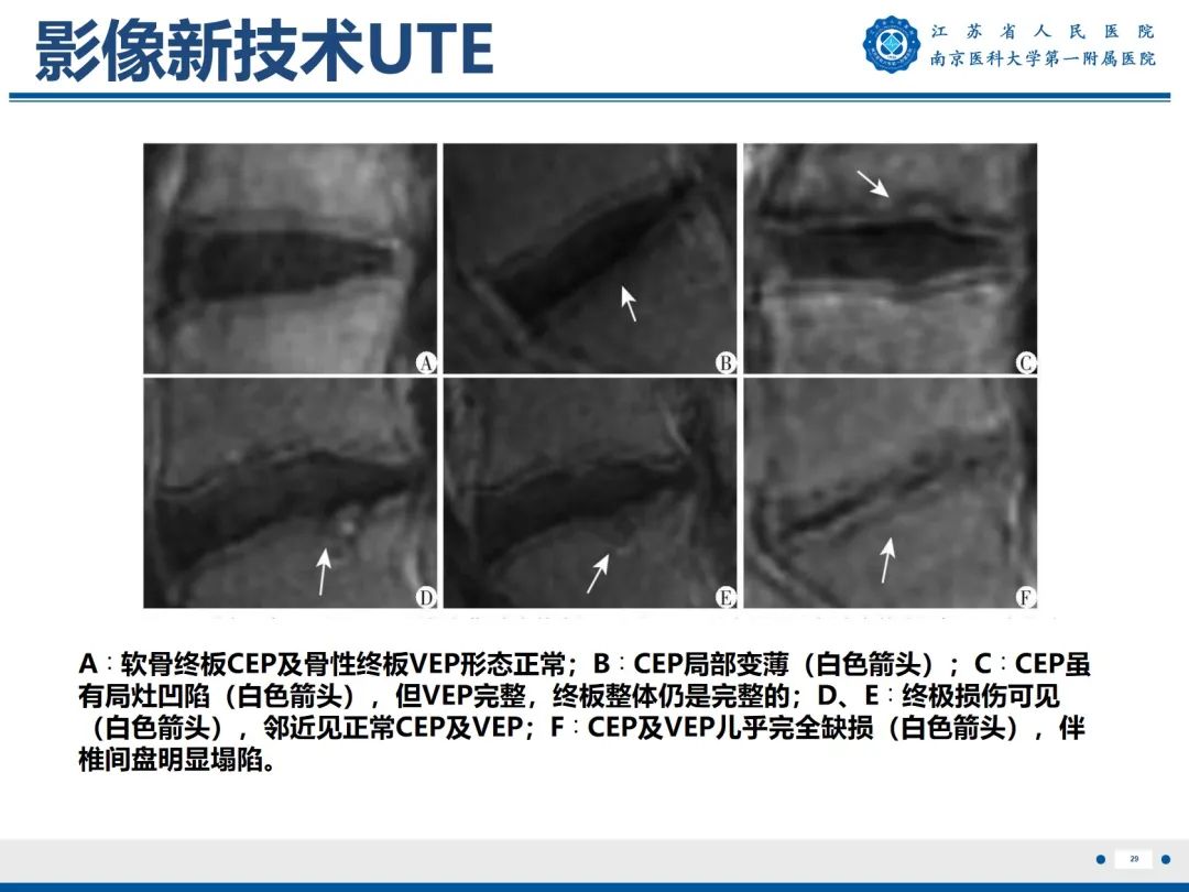 影像PPT - 【PPT】终板炎-30