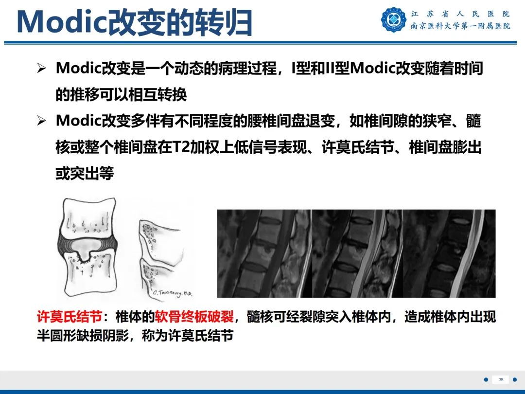 影像PPT - 【PPT】终板炎-31