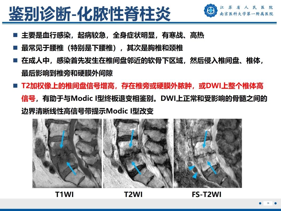 影像PPT - 【PPT】终板炎-36