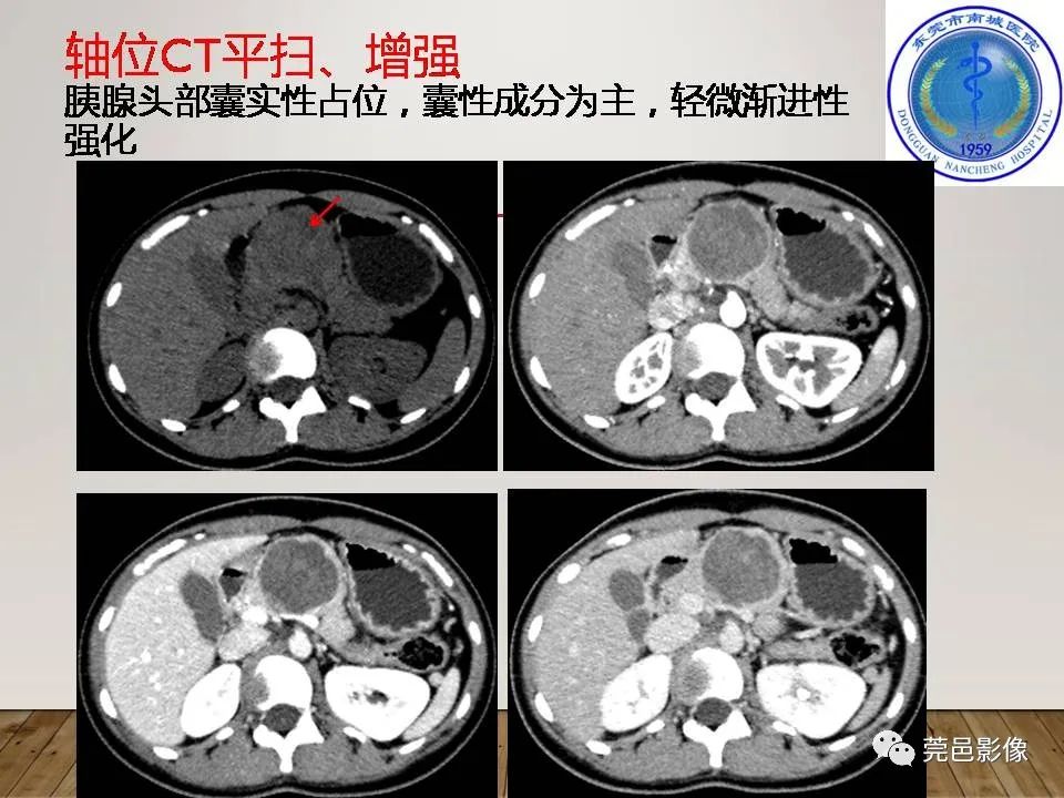 影像PPT - 【PPT】胰腺实性假乳头状瘤(SPTP)的CT诊断-3