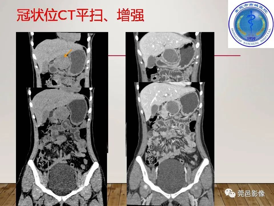 影像PPT - 【PPT】胰腺实性假乳头状瘤(SPTP)的CT诊断-5