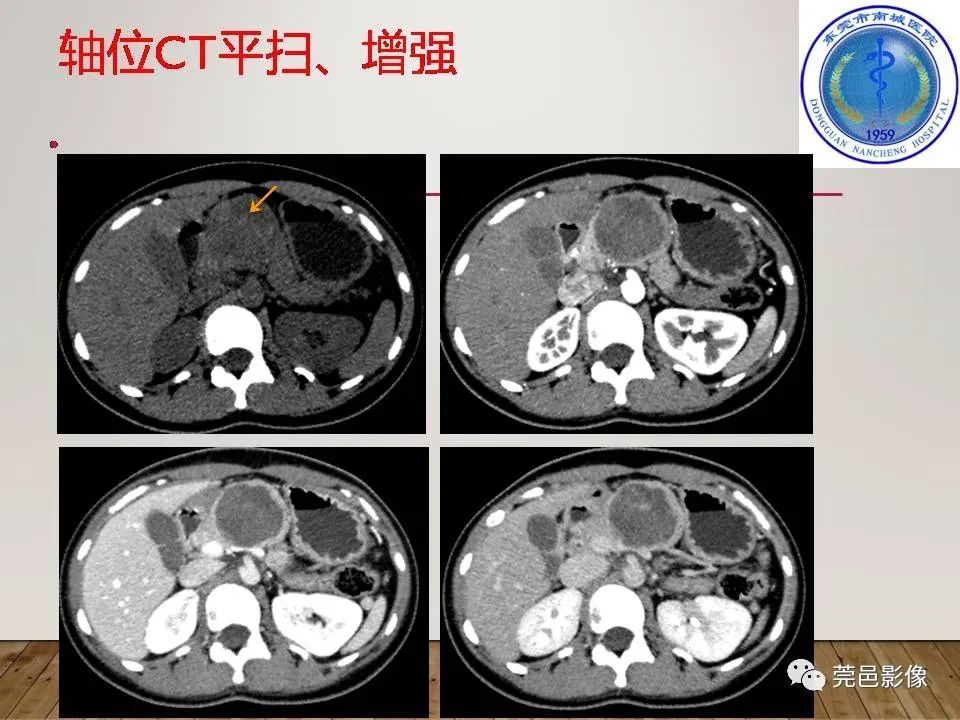 影像PPT - 【PPT】胰腺实性假乳头状瘤(SPTP)的CT诊断-4