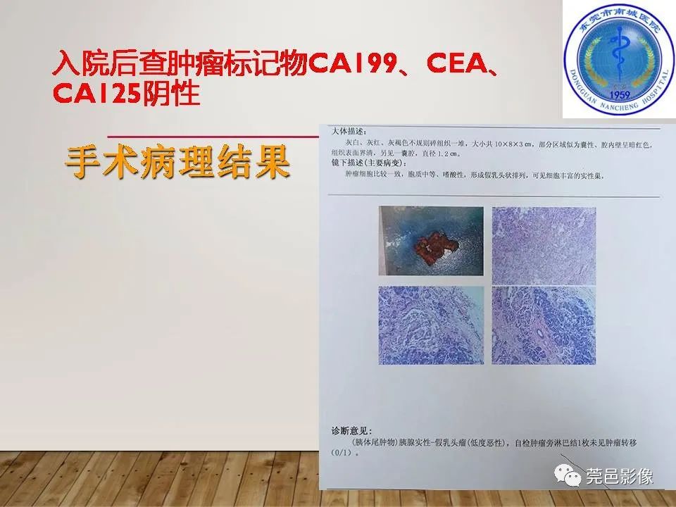 影像PPT - 【PPT】胰腺实性假乳头状瘤(SPTP)的CT诊断-6