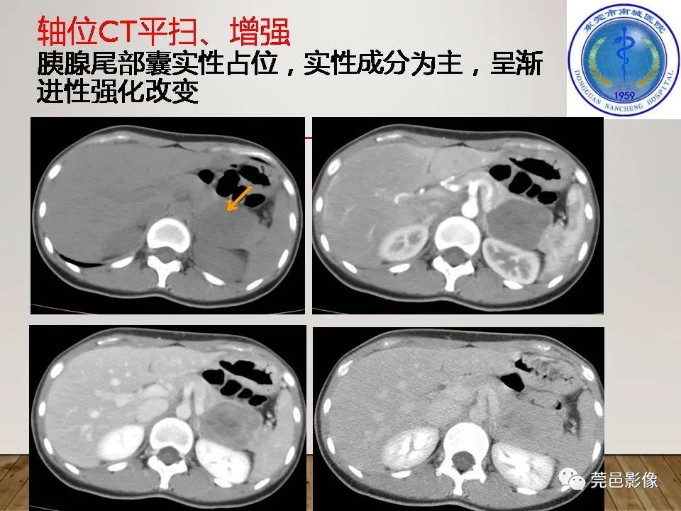 影像PPT - 【PPT】胰腺实性假乳头状瘤(SPTP)的CT诊断-8