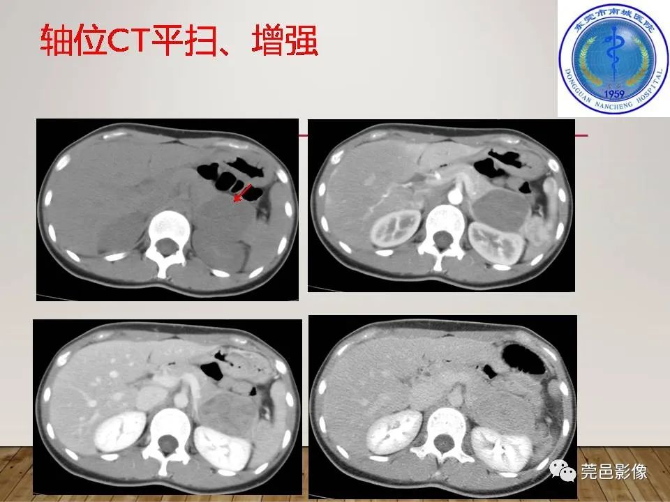 影像PPT - 【PPT】胰腺实性假乳头状瘤(SPTP)的CT诊断-9