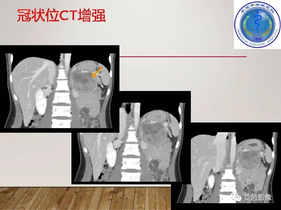影像PPT - 【PPT】胰腺实性假乳头状瘤(SPTP)的CT诊断-10