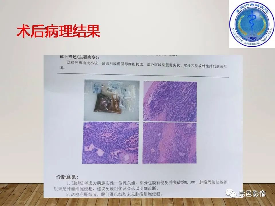 影像PPT - 【PPT】胰腺实性假乳头状瘤(SPTP)的CT诊断-11