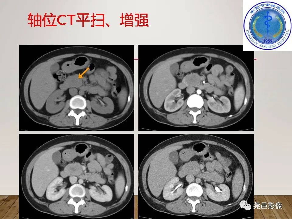 影像PPT - 【PPT】胰腺实性假乳头状瘤(SPTP)的CT诊断-14