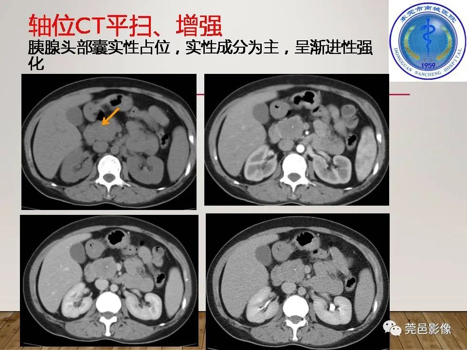 影像PPT - 【PPT】胰腺实性假乳头状瘤(SPTP)的CT诊断-13