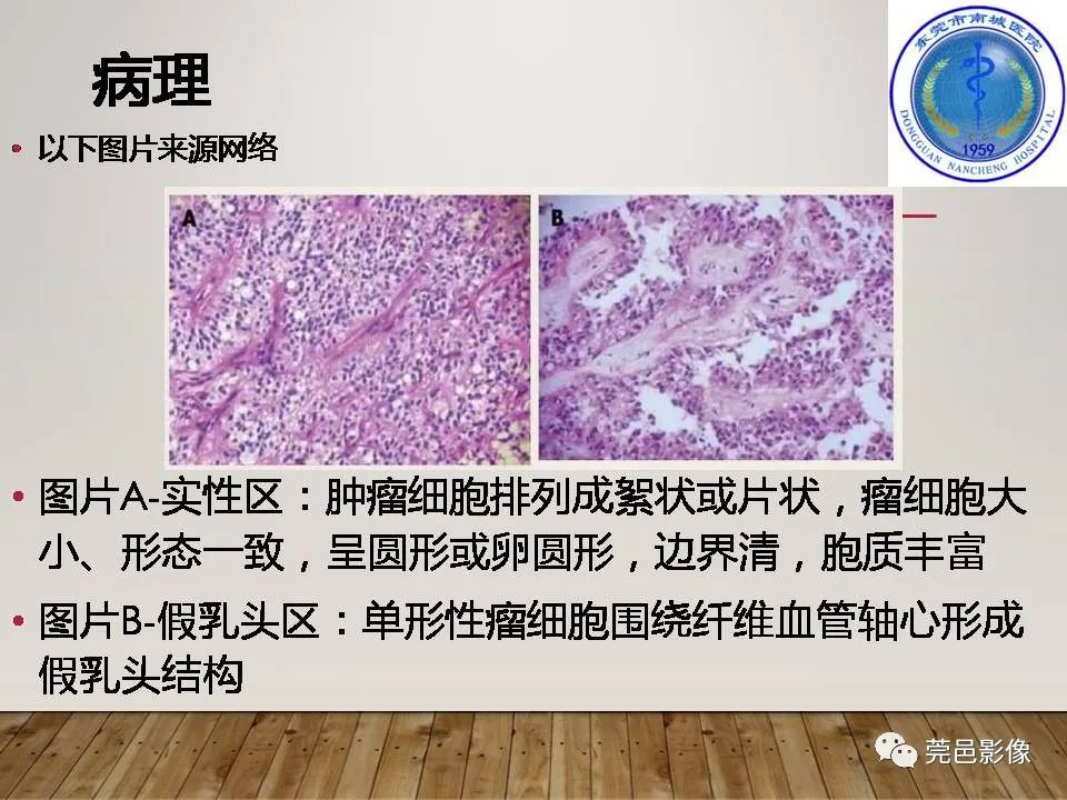 影像PPT - 【PPT】胰腺实性假乳头状瘤(SPTP)的CT诊断-19