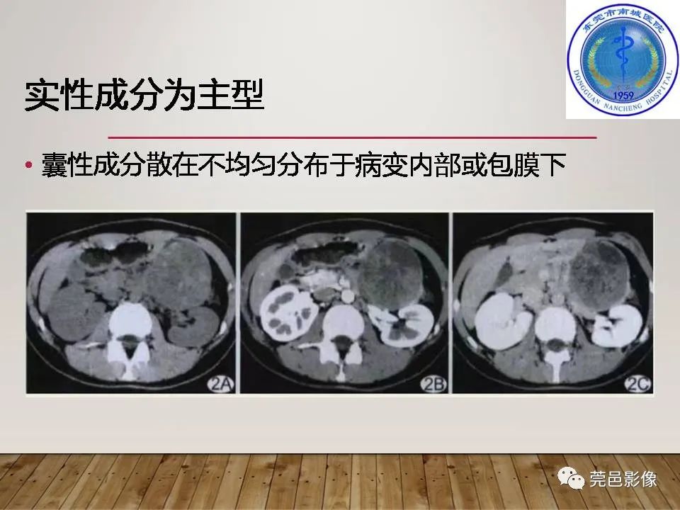 影像PPT - 【PPT】胰腺实性假乳头状瘤(SPTP)的CT诊断-26