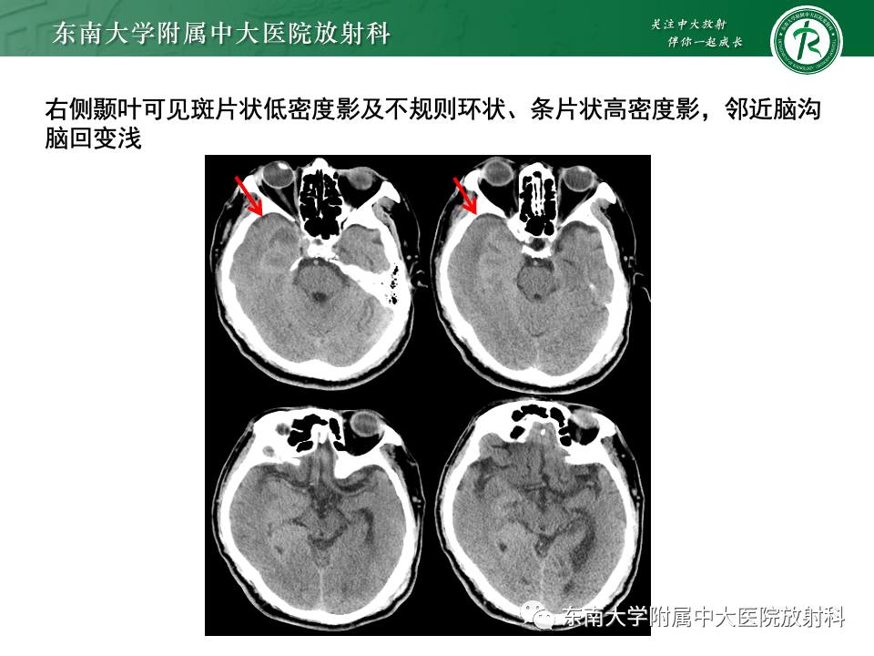 影像PPT - 【病例】胶质母细胞瘤 VS 原发性中枢神经系统淋巴瘤-7 影像PPT - 【病例】胶质母细胞瘤 VS 原发性中枢神经系统淋巴瘤-7