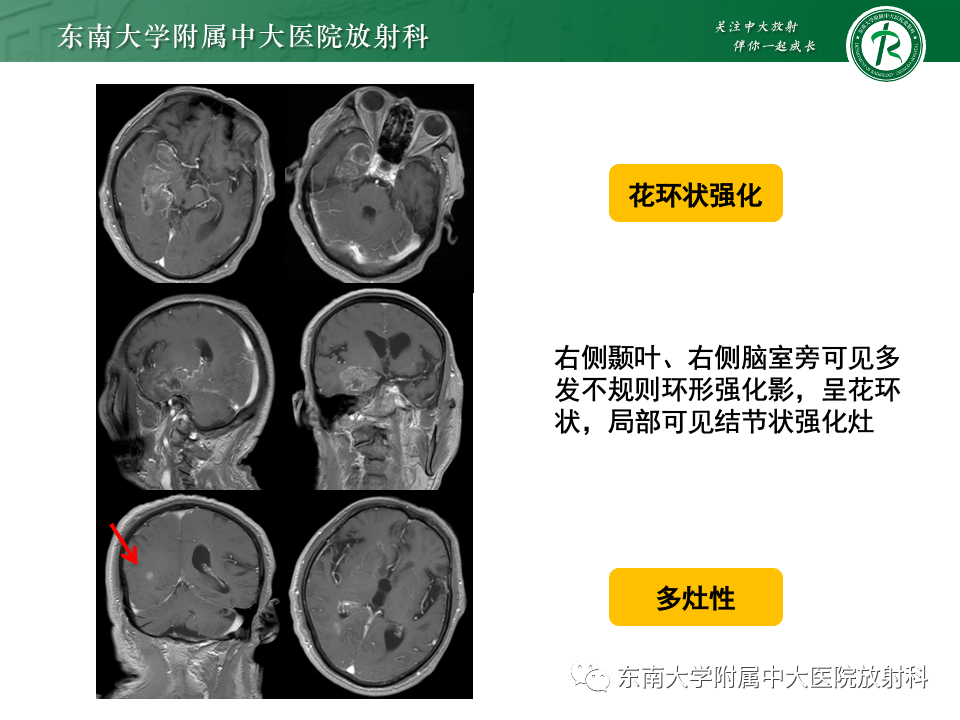 影像PPT - 【病例】胶质母细胞瘤 VS 原发性中枢神经系统淋巴瘤-9 影像PPT - 【病例】胶质母细胞瘤 VS 原发性中枢神经系统淋巴瘤-9