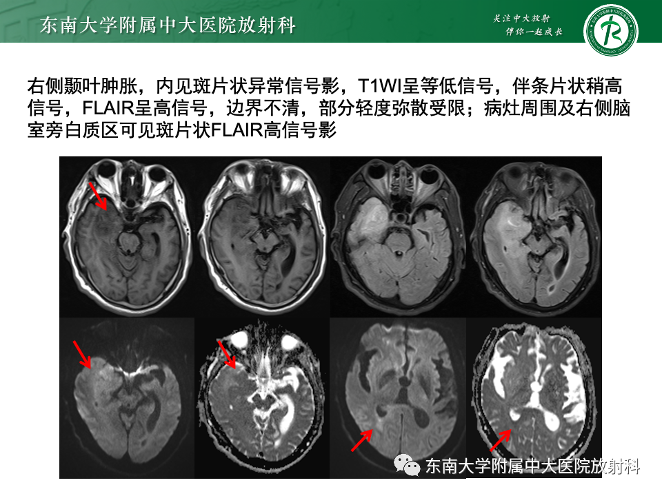影像PPT - 【病例】胶质母细胞瘤 VS 原发性中枢神经系统淋巴瘤-8 影像PPT - 【病例】胶质母细胞瘤 VS 原发性中枢神经系统淋巴瘤-8