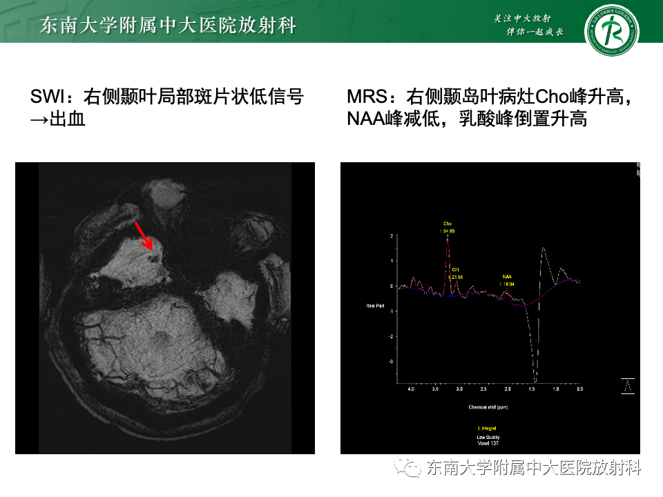 影像PPT - 【病例】胶质母细胞瘤 VS 原发性中枢神经系统淋巴瘤-10 影像PPT - 【病例】胶质母细胞瘤 VS 原发性中枢神经系统淋巴瘤-10