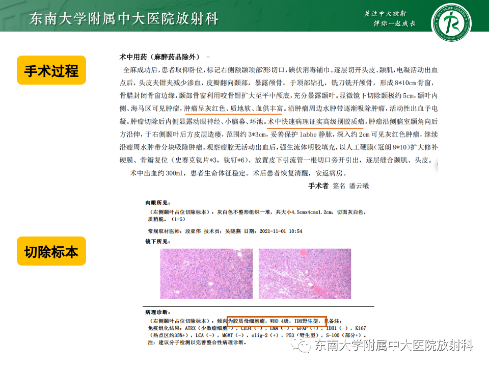 影像PPT - 【病例】胶质母细胞瘤 VS 原发性中枢神经系统淋巴瘤-12 影像PPT - 【病例】胶质母细胞瘤 VS 原发性中枢神经系统淋巴瘤-12