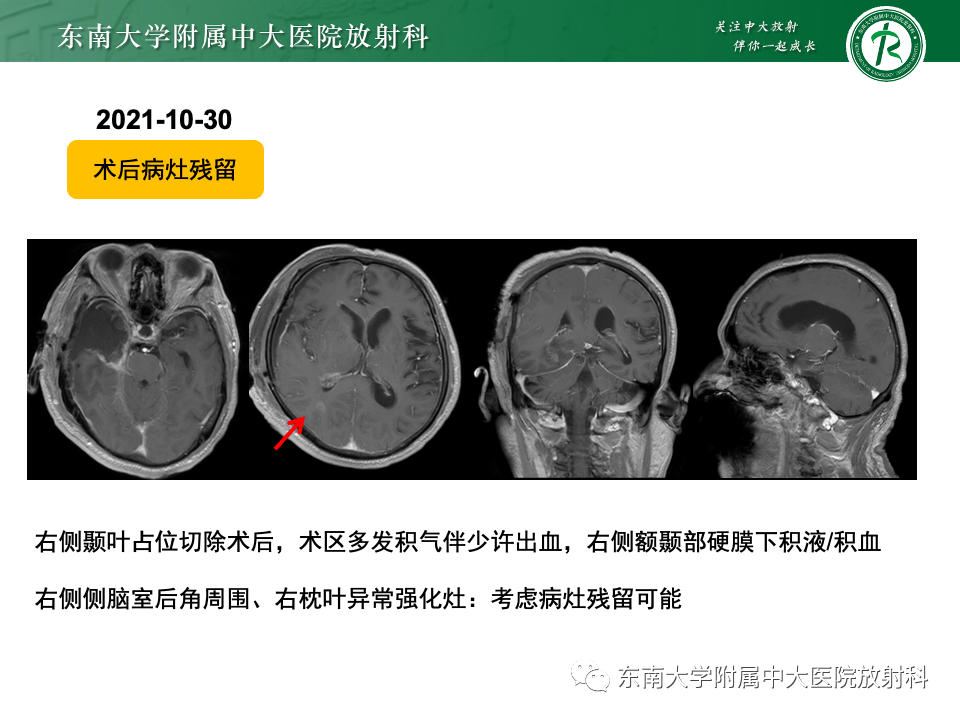 影像PPT - 【病例】胶质母细胞瘤 VS 原发性中枢神经系统淋巴瘤-14 影像PPT - 【病例】胶质母细胞瘤 VS 原发性中枢神经系统淋巴瘤-14