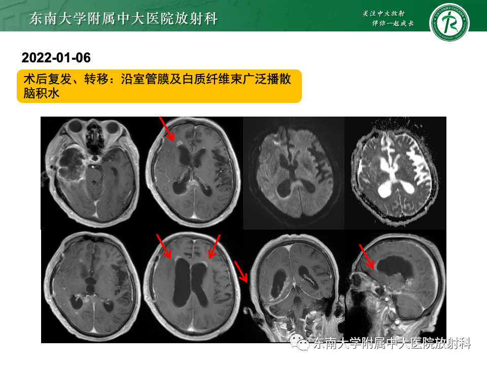 影像PPT - 【病例】胶质母细胞瘤 VS 原发性中枢神经系统淋巴瘤-15 影像PPT - 【病例】胶质母细胞瘤 VS 原发性中枢神经系统淋巴瘤-15