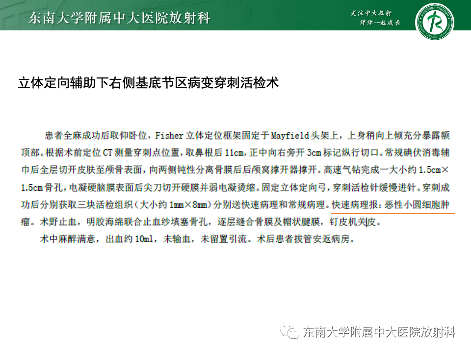 影像PPT - 【病例】胶质母细胞瘤 VS 原发性中枢神经系统淋巴瘤-18 影像PPT - 【病例】胶质母细胞瘤 VS 原发性中枢神经系统淋巴瘤-18