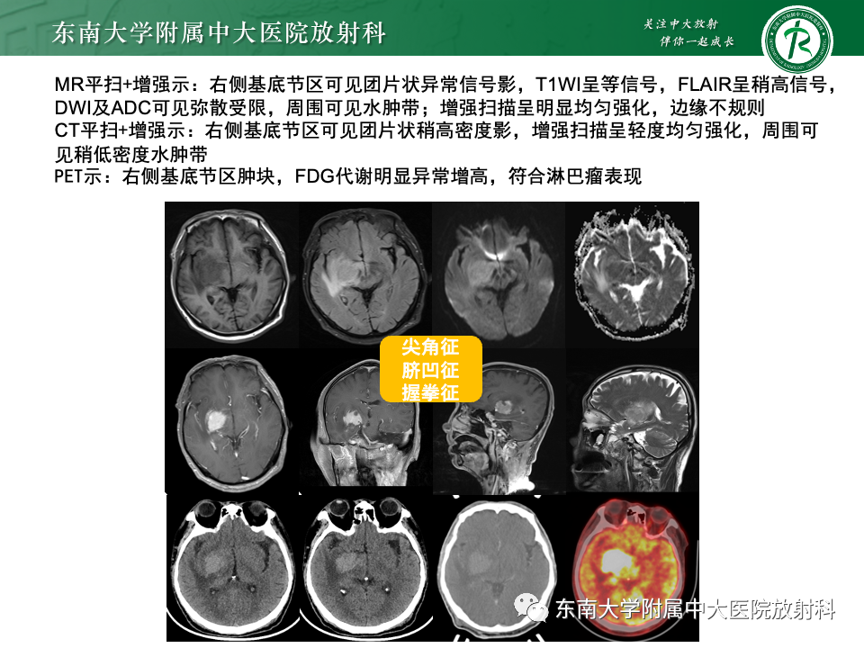 影像PPT - 【病例】胶质母细胞瘤 VS 原发性中枢神经系统淋巴瘤-17 影像PPT - 【病例】胶质母细胞瘤 VS 原发性中枢神经系统淋巴瘤-17
