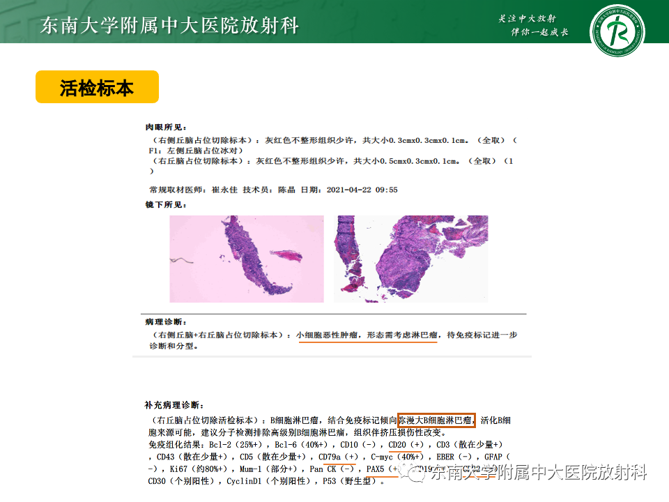 影像PPT - 【病例】胶质母细胞瘤 VS 原发性中枢神经系统淋巴瘤-19 影像PPT - 【病例】胶质母细胞瘤 VS 原发性中枢神经系统淋巴瘤-19