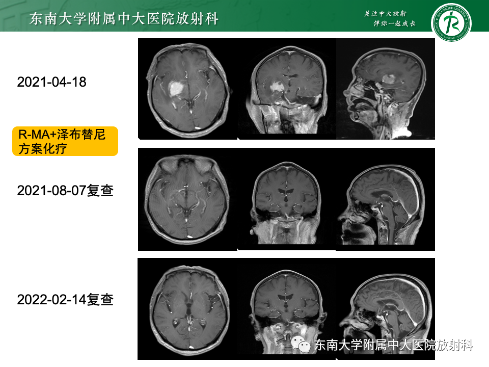 影像PPT - 【病例】胶质母细胞瘤 VS 原发性中枢神经系统淋巴瘤-21 影像PPT - 【病例】胶质母细胞瘤 VS 原发性中枢神经系统淋巴瘤-21