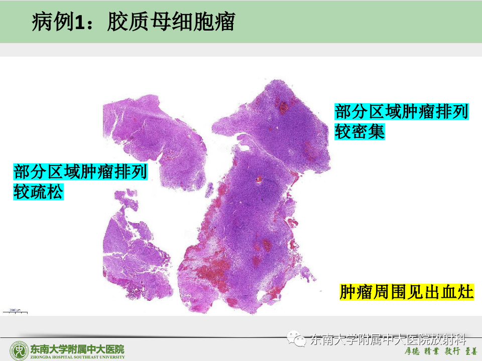 影像PPT - 【病例】胶质母细胞瘤 VS 原发性中枢神经系统淋巴瘤-25 影像PPT - 【病例】胶质母细胞瘤 VS 原发性中枢神经系统淋巴瘤-25