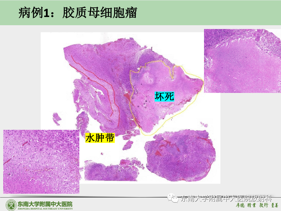影像PPT - 【病例】胶质母细胞瘤 VS 原发性中枢神经系统淋巴瘤-26 影像PPT - 【病例】胶质母细胞瘤 VS 原发性中枢神经系统淋巴瘤-26