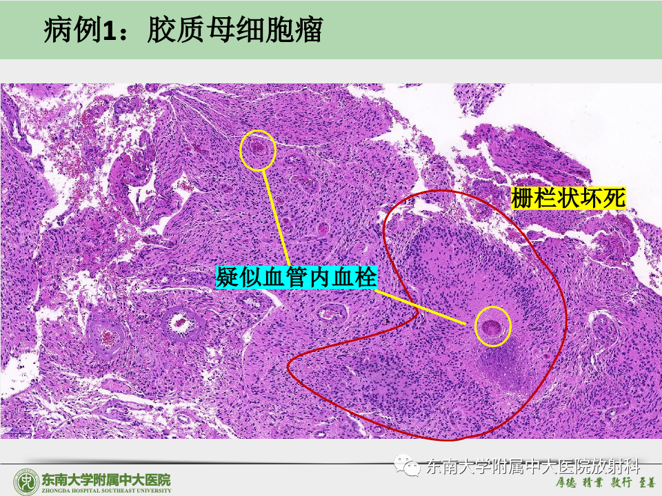 影像PPT - 【病例】胶质母细胞瘤 VS 原发性中枢神经系统淋巴瘤-28 影像PPT - 【病例】胶质母细胞瘤 VS 原发性中枢神经系统淋巴瘤-28