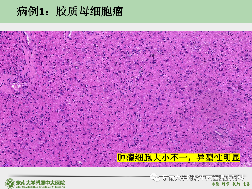 影像PPT - 【病例】胶质母细胞瘤 VS 原发性中枢神经系统淋巴瘤-30 影像PPT - 【病例】胶质母细胞瘤 VS 原发性中枢神经系统淋巴瘤-30