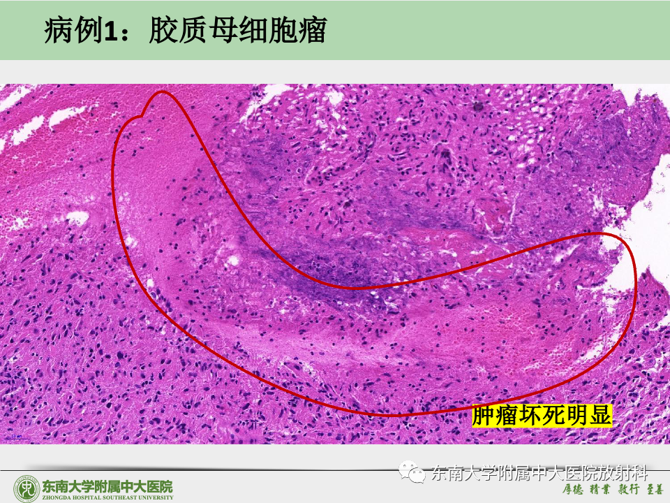 影像PPT - 【病例】胶质母细胞瘤 VS 原发性中枢神经系统淋巴瘤-27 影像PPT - 【病例】胶质母细胞瘤 VS 原发性中枢神经系统淋巴瘤-27